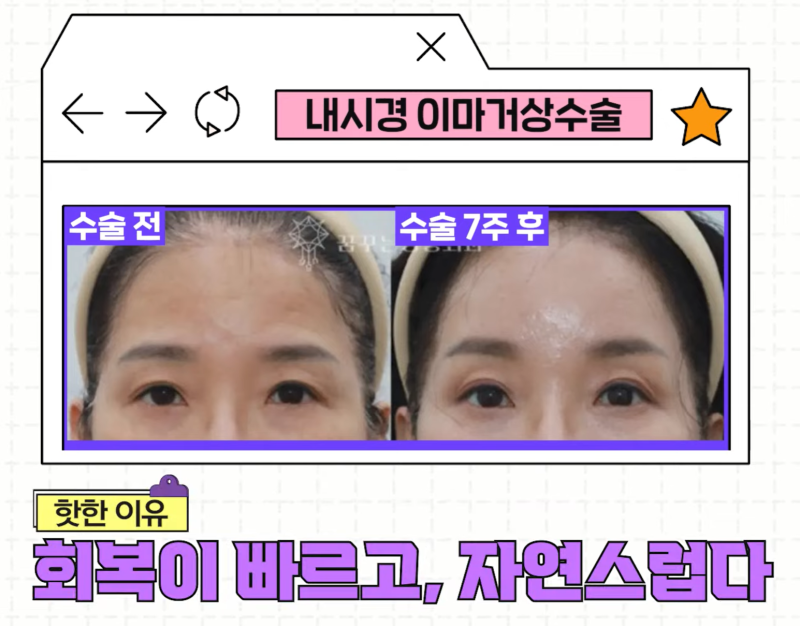 [강남 꿈꾸는성형외과] 족집게 과외 / 나에게 맞는 안티에이징 찾아드림!! 사진 10
