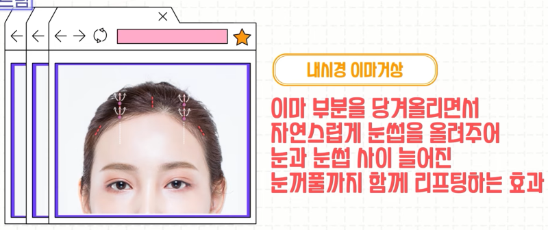 [강남 꿈꾸는성형외과] 족집게 과외 / 나에게 맞는 안티에이징 찾아드림!! 사진 9