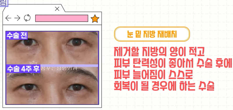 [강남 꿈꾸는성형외과] 족집게 과외 / 나에게 맞는 안티에이징 찾아드림!! 사진 19