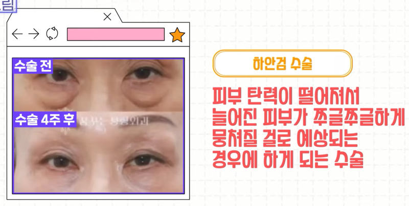 [강남 꿈꾸는성형외과] 족집게 과외 / 나에게 맞는 안티에이징 찾아드림!! 사진 20