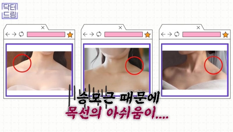 [강남 꿈꾸는 성형외과] 웨딩시즌! 결혼 전 준비해야 할 성형 꿀팁 2탄(3개월 ~ 본식 당일) 사진 5