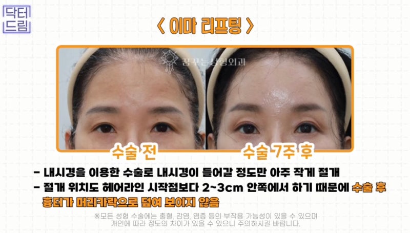 [강남 꿈꾸는성형외과] 성형 후 흉터 걱정 NO! 티 안 나게 젊고 예뻐지는 3가지 꿀팁! 사진 12