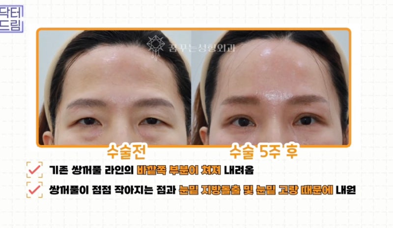 [강남 꿈꾸는성형외과] 성형 후 흉터 걱정 NO! 티 안 나게 젊고 예뻐지는 3가지 꿀팁! 사진 18