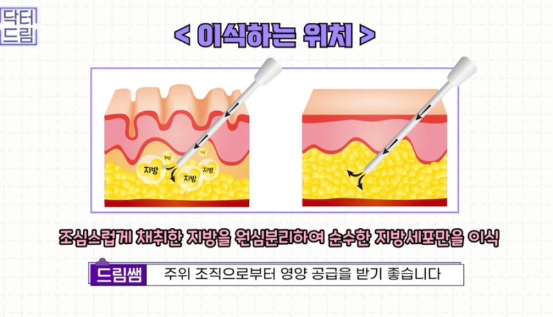 [강남꿈꾸는성형외과]볼륨UP! 탄력UP! 피부톤UP! 지방이식 제대로 알고하자! 사진 12