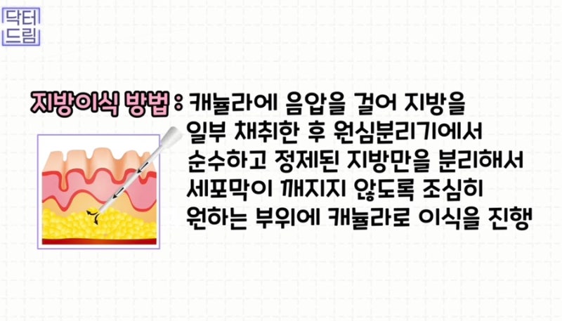 [강남꿈꾸는성형외과]볼륨UP! 탄력UP! 피부톤UP! 지방이식 제대로 알고하자! 사진 14