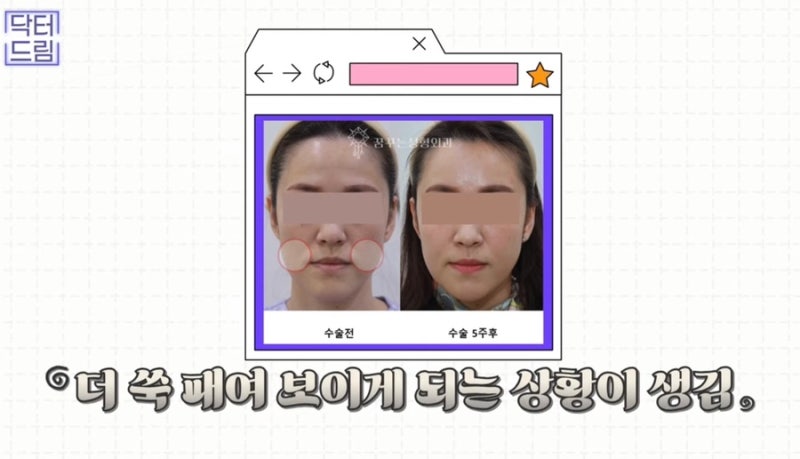 [강남꿈꾸는성형외과]볼륨UP! 탄력UP! 피부톤UP! 지방이식 제대로 알고하자! 사진 4