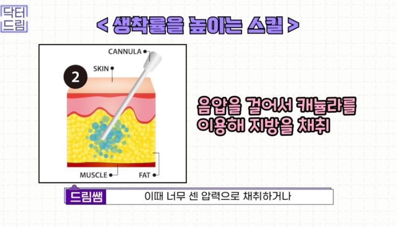 [강남꿈꾸는성형외과]볼륨UP! 탄력UP! 피부톤UP! 지방이식 제대로 알고하자! 사진 11