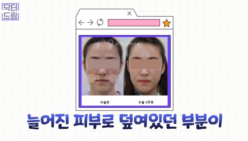 [강남꿈꾸는성형외과]볼륨UP! 탄력UP! 피부톤UP! 지방이식 제대로 알고하자! 사진 3