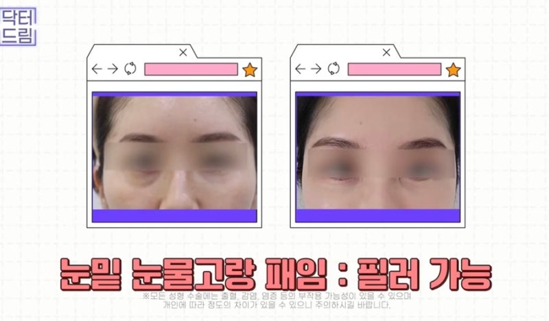 [강남 꿈꾸는 성형외과] 동안 비법 ㅣ 지방이식 vs 필러 시술 사진 11