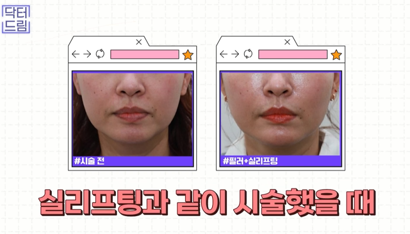 [강남 꿈꾸는 성형외과] 동안 비법 ㅣ 지방이식 vs 필러 시술 사진 16