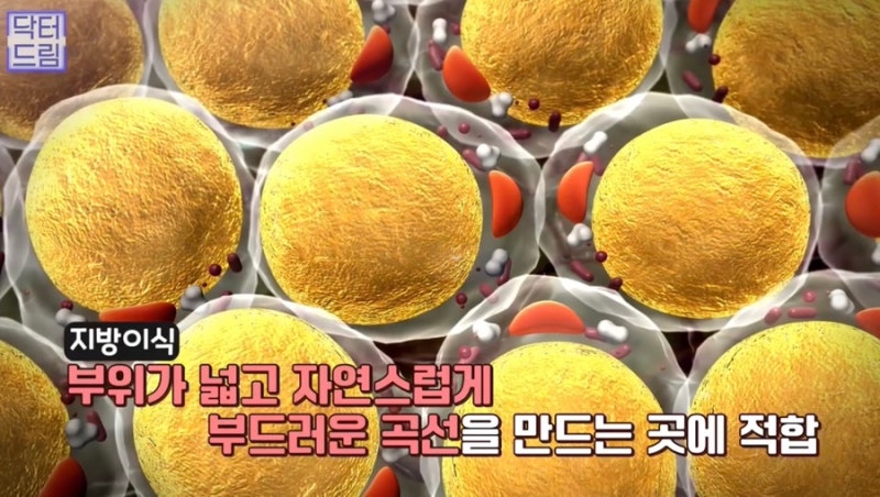 [강남 꿈꾸는 성형외과] 동안 비법 ㅣ 지방이식 vs 필러 시술