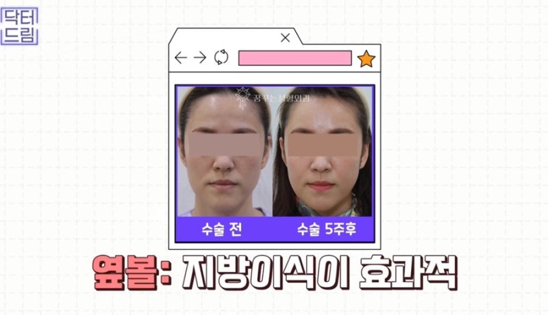 [강남 꿈꾸는 성형외과] 동안 비법 ㅣ 지방이식 vs 필러 시술 사진 14