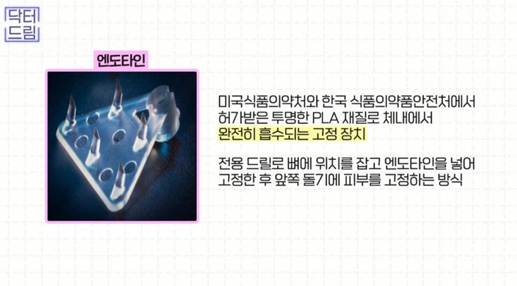 [강남꿈꾸는성형외과] 나이, 주름 실종! 중년 안면거상술은 무엇일까? 사진 3