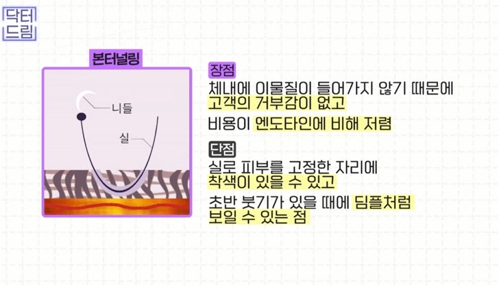 [강남꿈꾸는성형외과] 나이, 주름 실종! 중년 안면거상술은 무엇일까?