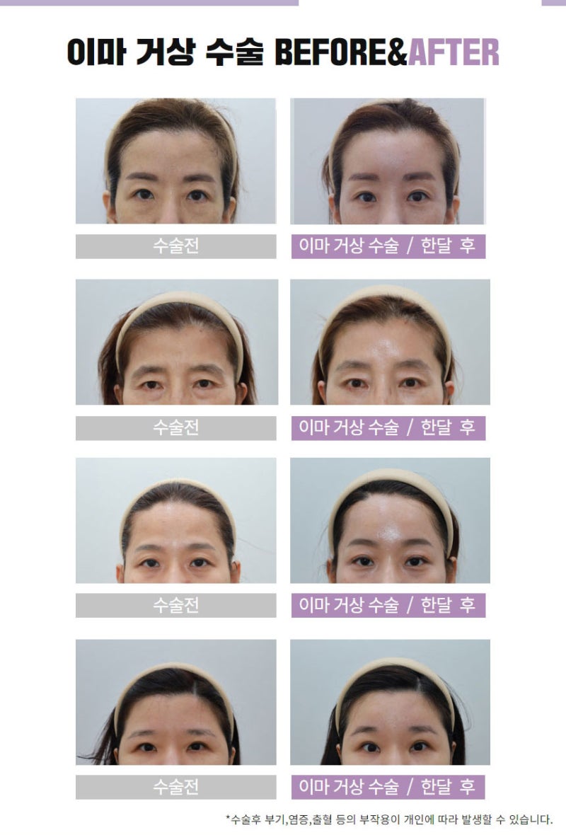 내시경이마거상 확실한 동안 비법 사진 9