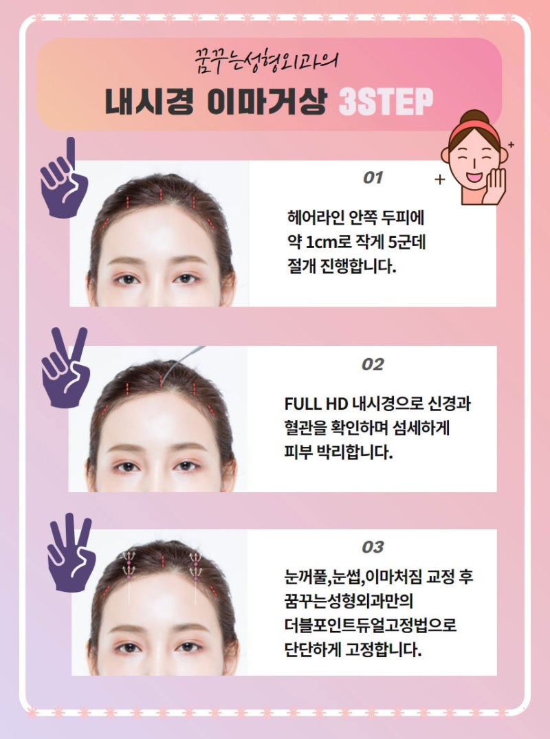 내시경이마거상 확실한 동안 비법 사진 7