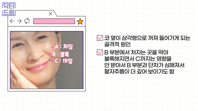 [강남꿈꾸는성형외과] 노화의 시작! 팔자주름 파헤치기 사진 13