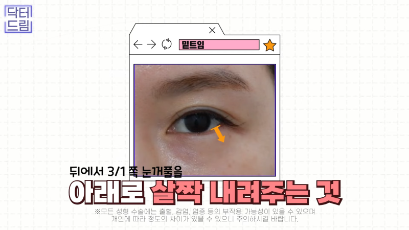 [강남꿈꾸는성형외과] 눈! 트임에 관한 모든 것!! 사진 22