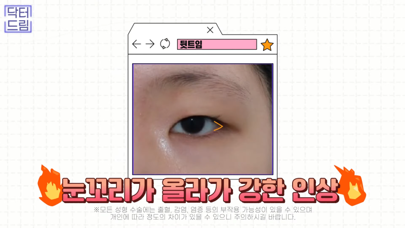 [강남꿈꾸는성형외과] 눈! 트임에 관한 모든 것!! 사진 20