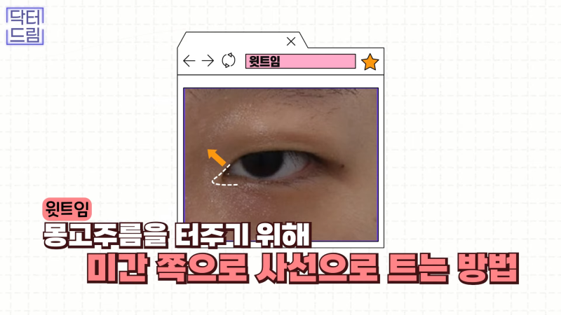 [강남꿈꾸는성형외과] 눈! 트임에 관한 모든 것!! 사진 18