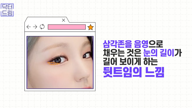 [강남꿈꾸는성형외과] 눈! 트임에 관한 모든 것!! 사진 4
