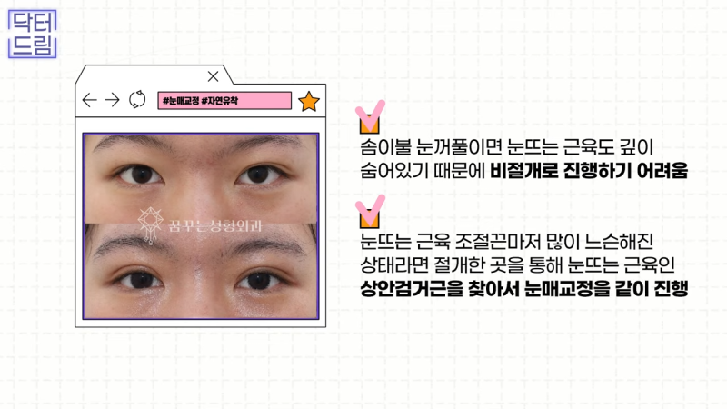 [강남 꿈꾸는 성형외과] 눈매교정에 대한 모든 것! 사진 19