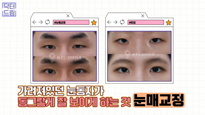 [강남 꿈꾸는 성형외과] 눈매교정에 대한 모든 것! 사진 14