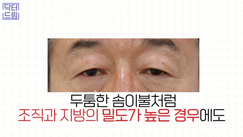 [강남 꿈꾸는 성형외과] 눈매교정에 대한 모든 것! 사진 9