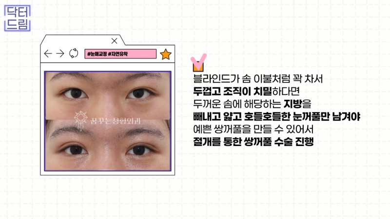 [강남 꿈꾸는 성형외과] 눈매교정에 대한 모든 것! 사진 18