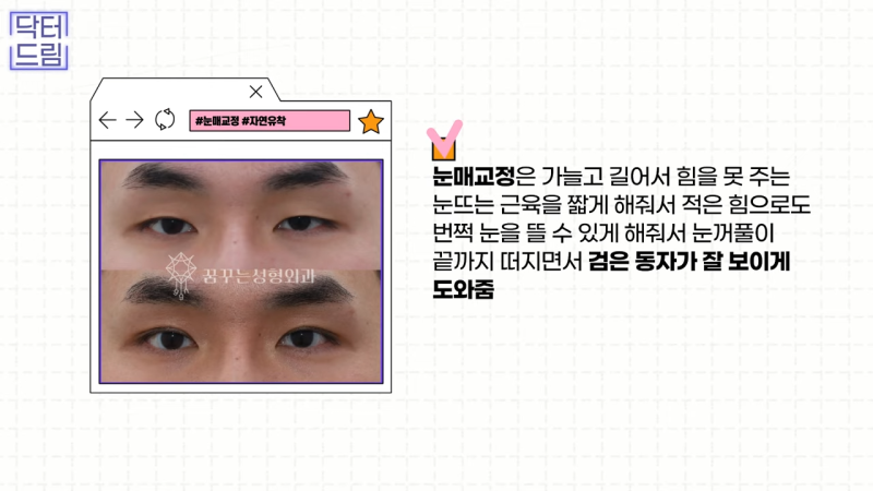 [강남 꿈꾸는 성형외과] 눈매교정에 대한 모든 것! 사진 16