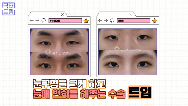 [강남 꿈꾸는 성형외과] 눈매교정에 대한 모든 것! 사진 15