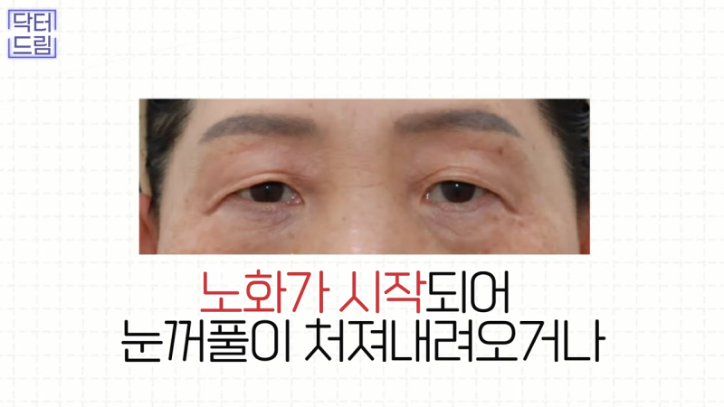[강남 꿈꾸는 성형외과] 눈매교정에 대한 모든 것! 사진 8