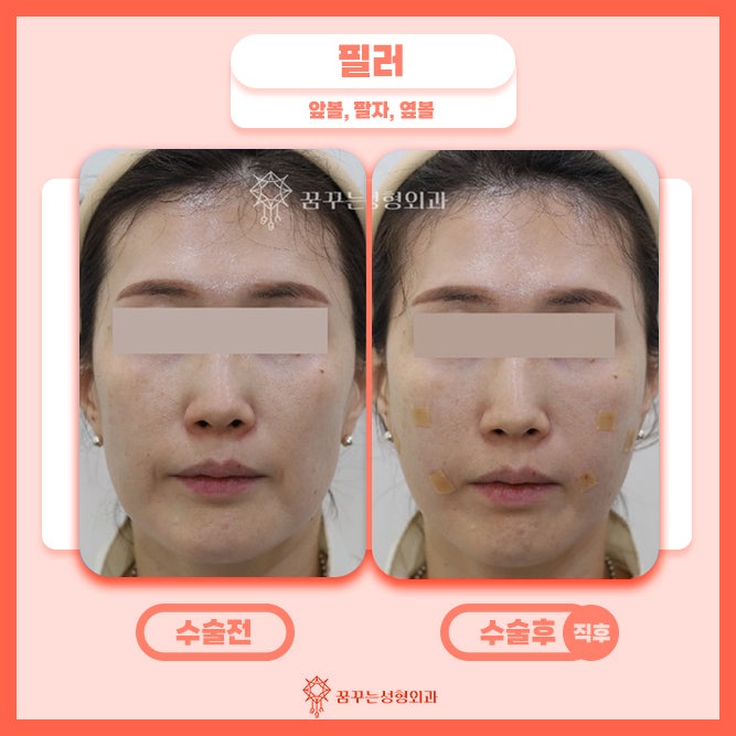 강남꿈꾸는성형외과/팔자필러 동안외모를 원한다면 사진 3