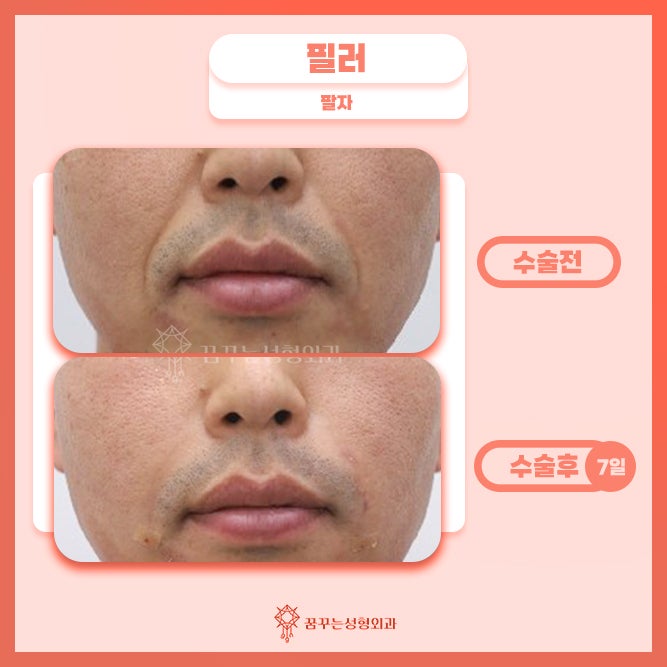 강남꿈꾸는성형외과/팔자필러 동안외모를 원한다면 사진 6