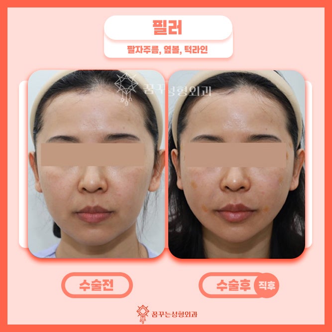 강남꿈꾸는성형외과/팔자필러 동안외모를 원한다면 사진 5
