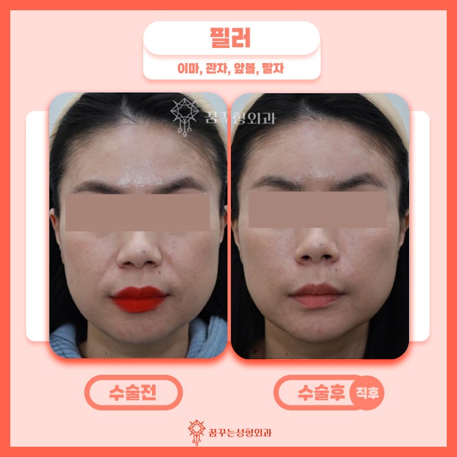강남꿈꾸는성형외과/팔자필러 동안외모를 원한다면 사진 4