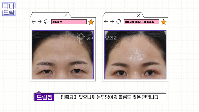 [강남 꿈꾸는 성형외과] 내시경 이마 리프팅 제대로 효과 보는 법 사진 15