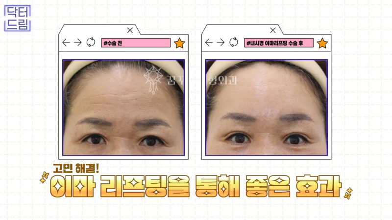 [강남 꿈꾸는 성형외과] 내시경 이마 리프팅 제대로 효과 보는 법 사진 13