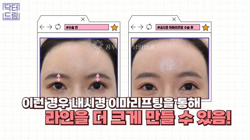 [강남 꿈꾸는 성형외과] 내시경 이마 리프팅 제대로 효과 보는 법 사진 8