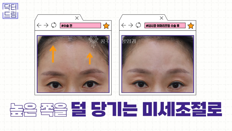 [강남 꿈꾸는 성형외과] 내시경 이마 리프팅 제대로 효과 보는 법 사진 17