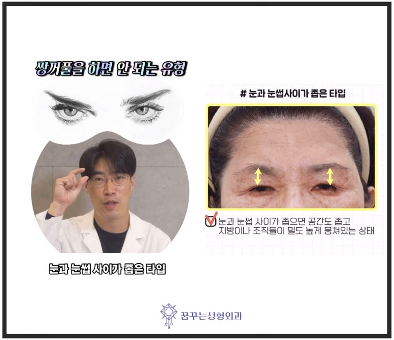 이마리프팅/이마거상-쌍꺼풀을 하면 안되는 유형은?[꿈꾸는성형외과]