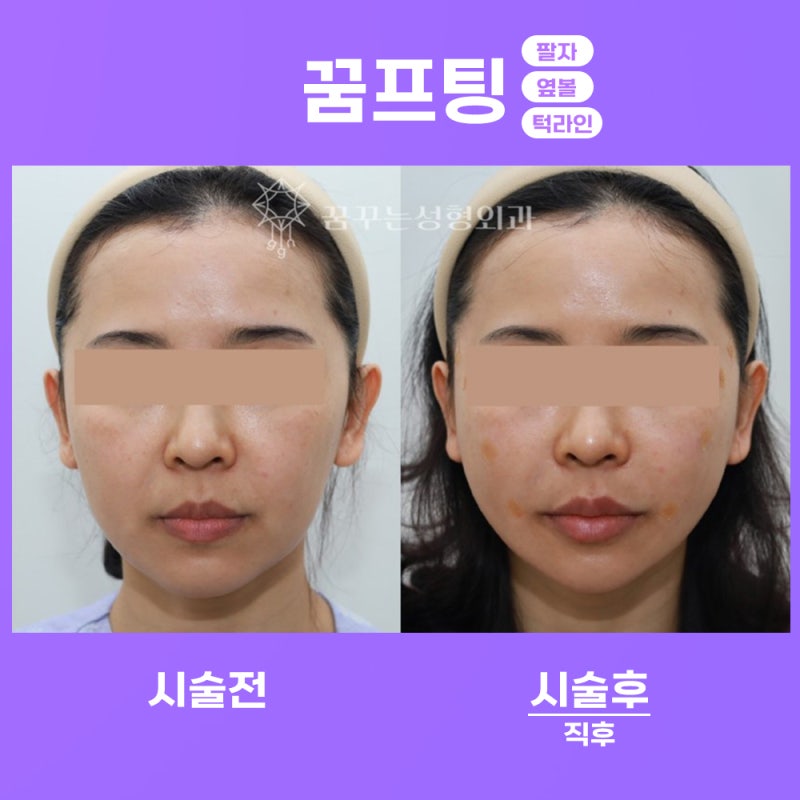 강남 실리프팅 알아보자_꿈꾸는성형외과 사진 7