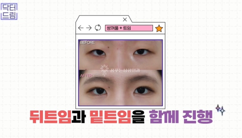 [강남꿈꾸는성형외과] 찰떡궁합! 함께하면 좋은 성형수술 사진 5