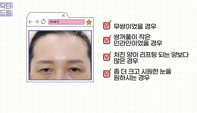 [강남꿈꾸는성형외과] 찰떡궁합! 함께하면 좋은 성형수술 사진 8