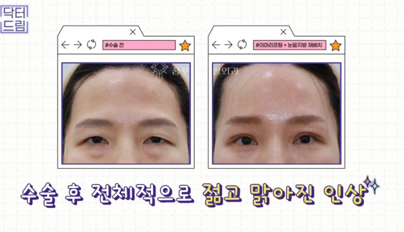 [강남꿈꾸는성형외과] 찰떡궁합! 함께하면 좋은 성형수술 사진 10