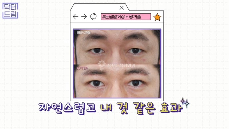 [강남꿈꾸는성형외과] 찰떡궁합! 함께하면 좋은 성형수술