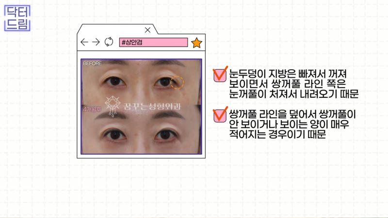 [강남꿈꾸는성형외과] 쌍수? 상안검? 내게 딱 맞는 눈 수술법 바로 알기! 사진 12