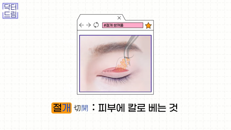 [강남꿈꾸는성형외과] 쌍수? 상안검? 내게 딱 맞는 눈 수술법 바로 알기!