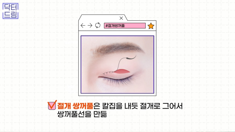 [강남꿈꾸는성형외과] 쌍수? 상안검? 내게 딱 맞는 눈 수술법 바로 알기! 사진 10