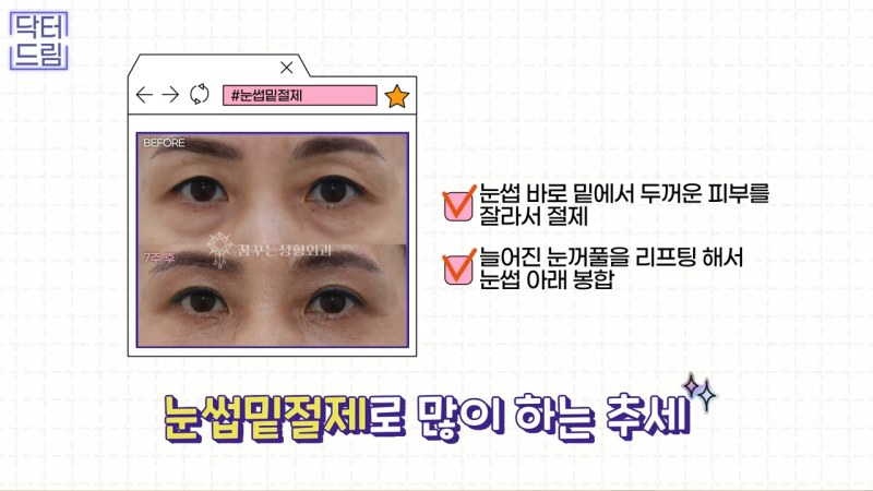 [강남꿈꾸는성형외과] 쌍수? 상안검? 내게 딱 맞는 눈 수술법 바로 알기! 사진 14